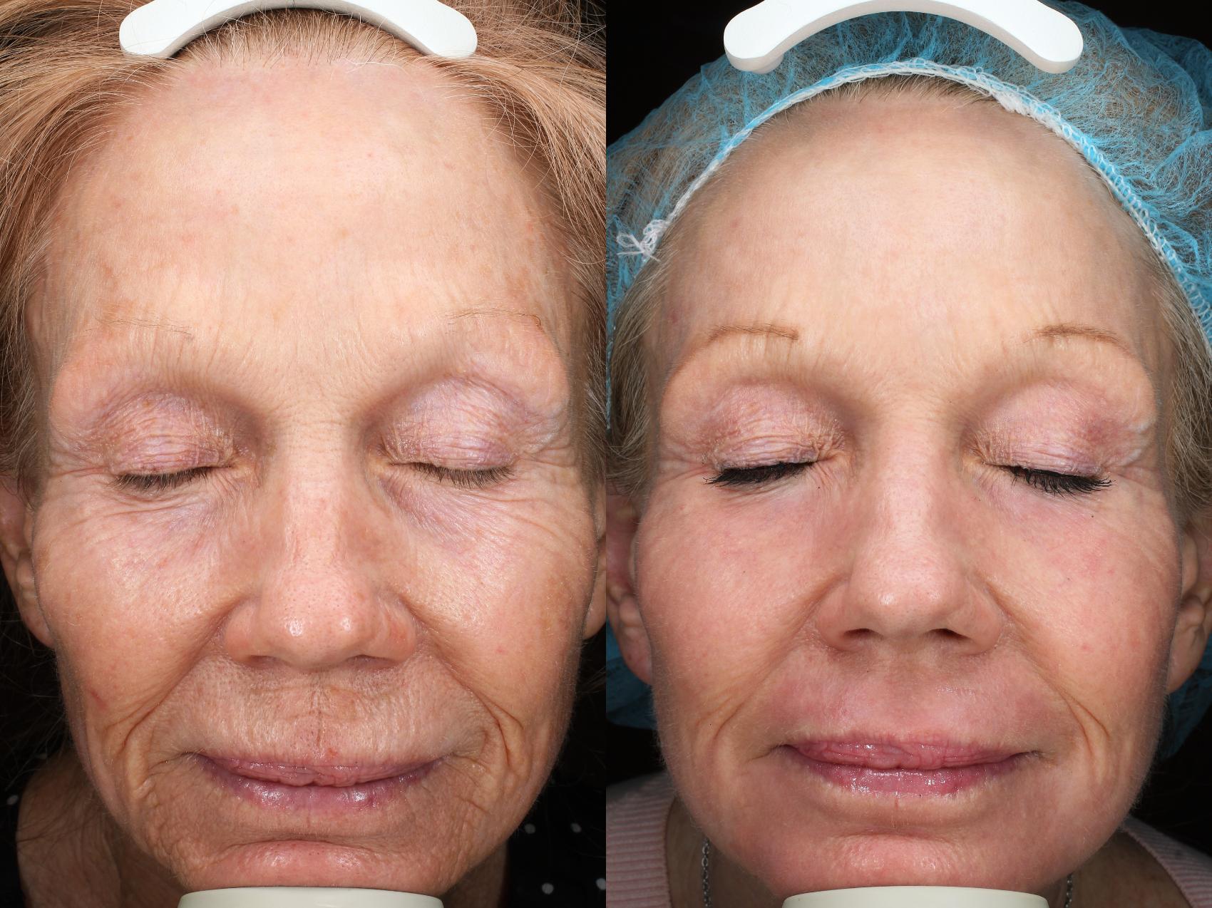 Before & After Contour TRL™ Laser Result 52 Front View in San Diego, Carlsbad, CA