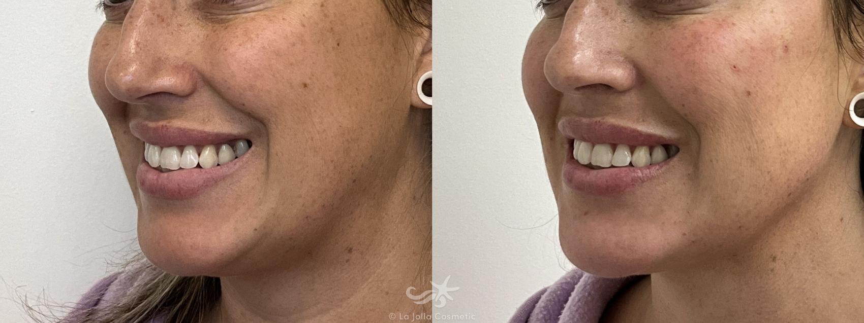 Before & After Juvéderm® Voluma™ Result 1001 Left Oblique Smile View in San Diego, Carlsbad, CA
