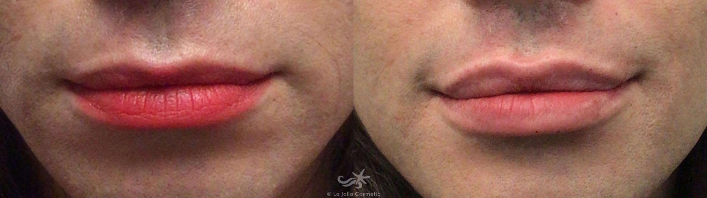 Before & After Restylane® Result 602 Front View in San Diego, Carlsbad, CA