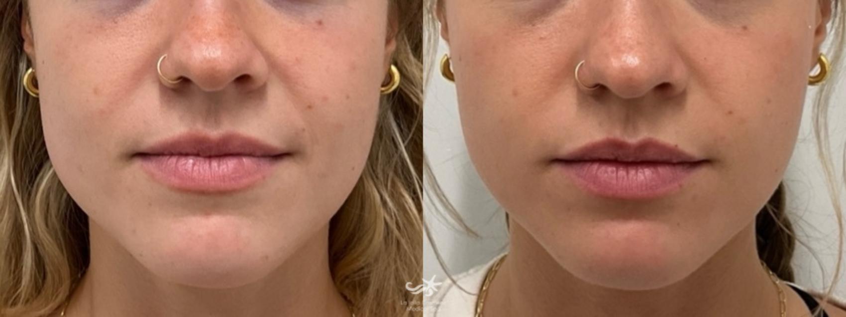 Before & After BOTOX® Cosmetic Result 1043 Front View in San Diego, Carlsbad, CA