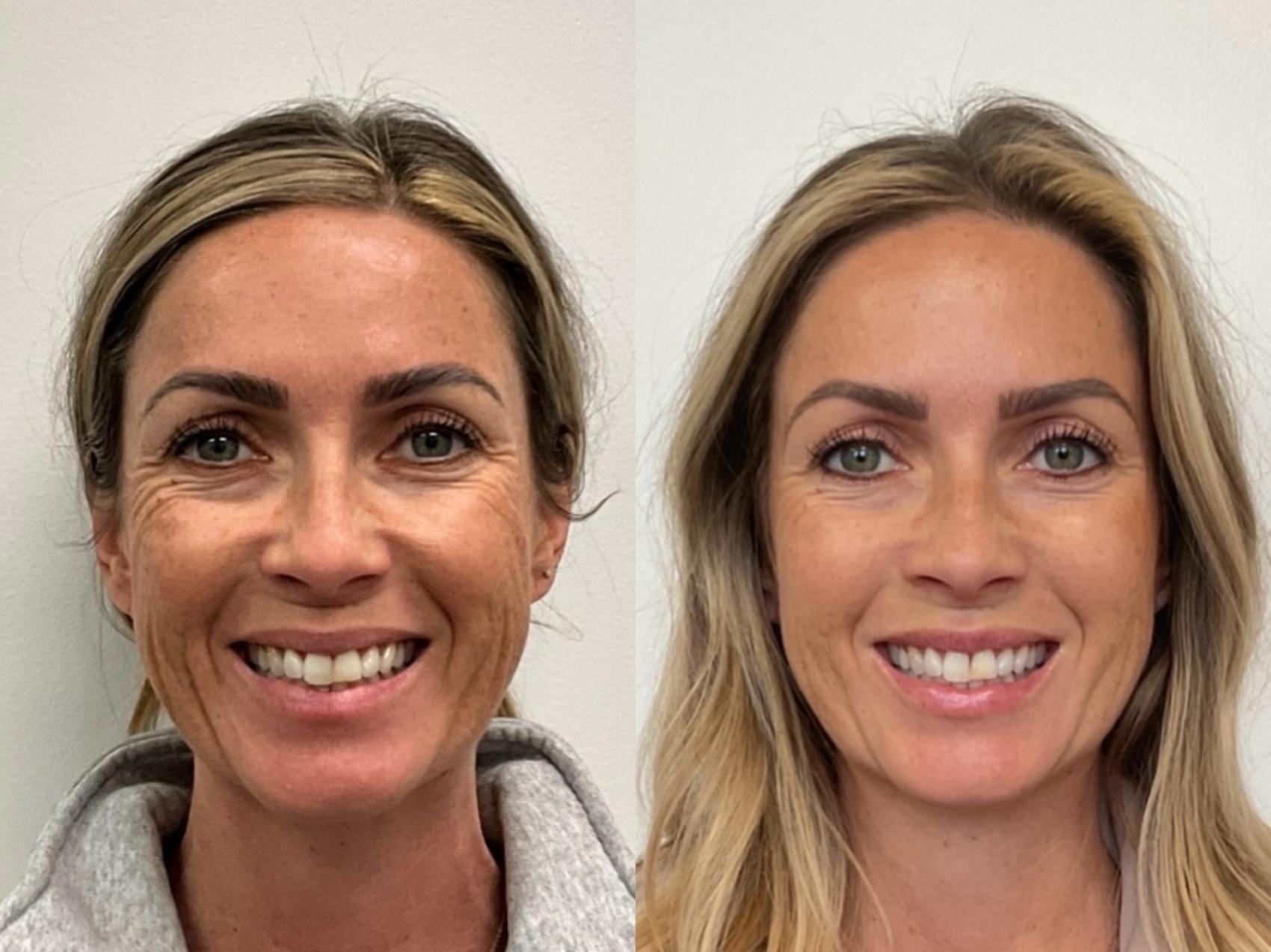 Before & After BOTOX® Cosmetic Result 1056 Front Smile View in San Diego, Carlsbad, CA