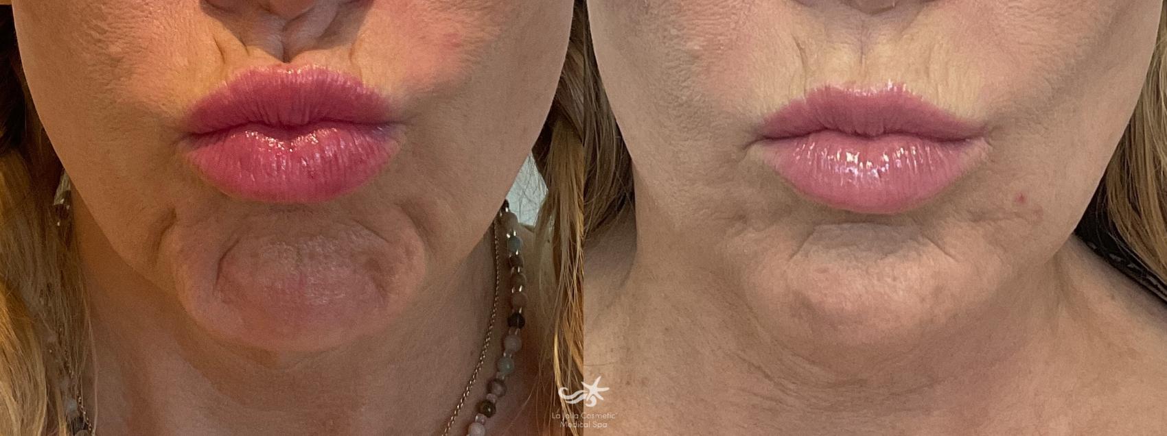 Before & After BOTOX® Cosmetic Result 848 Front View in San Diego, Carlsbad, CA