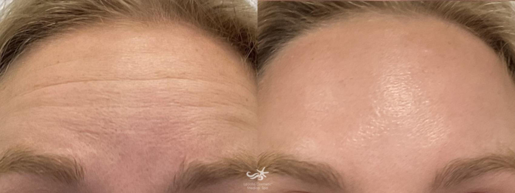 Before & After BOTOX® Cosmetic Result 890 Front View in San Diego, Carlsbad, CA