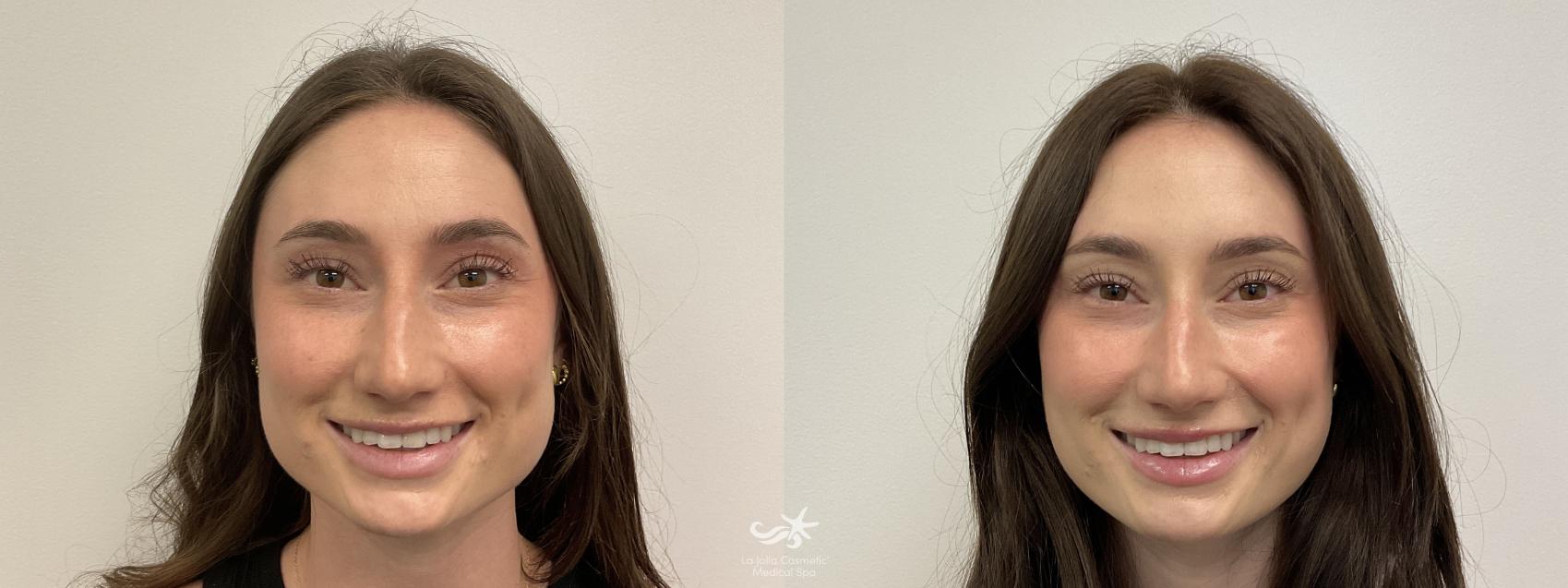 Before & After BOTOX® Cosmetic Result 905 Front View in San Diego, Carlsbad, CA