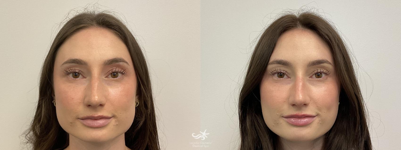 Before & After BOTOX® Cosmetic Result 905 Front No Expression View in San Diego, Carlsbad, CA