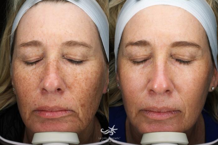 BBL® Laser Skin Rejuvenation Before and After Pictures Case 252