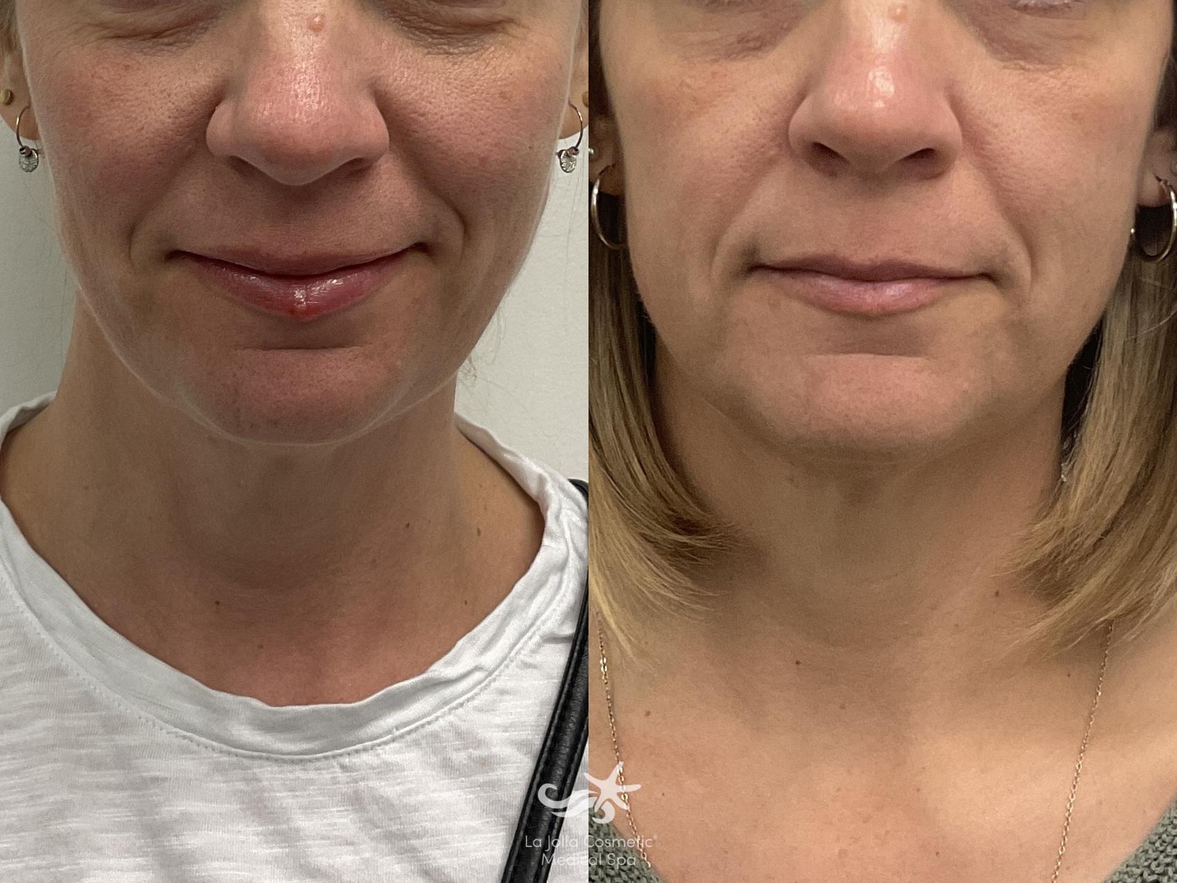 Before & After Collagen Stimulators (Sculptra, Radiesse, PDO) Result 1054 Front View in San Diego, Carlsbad, CA