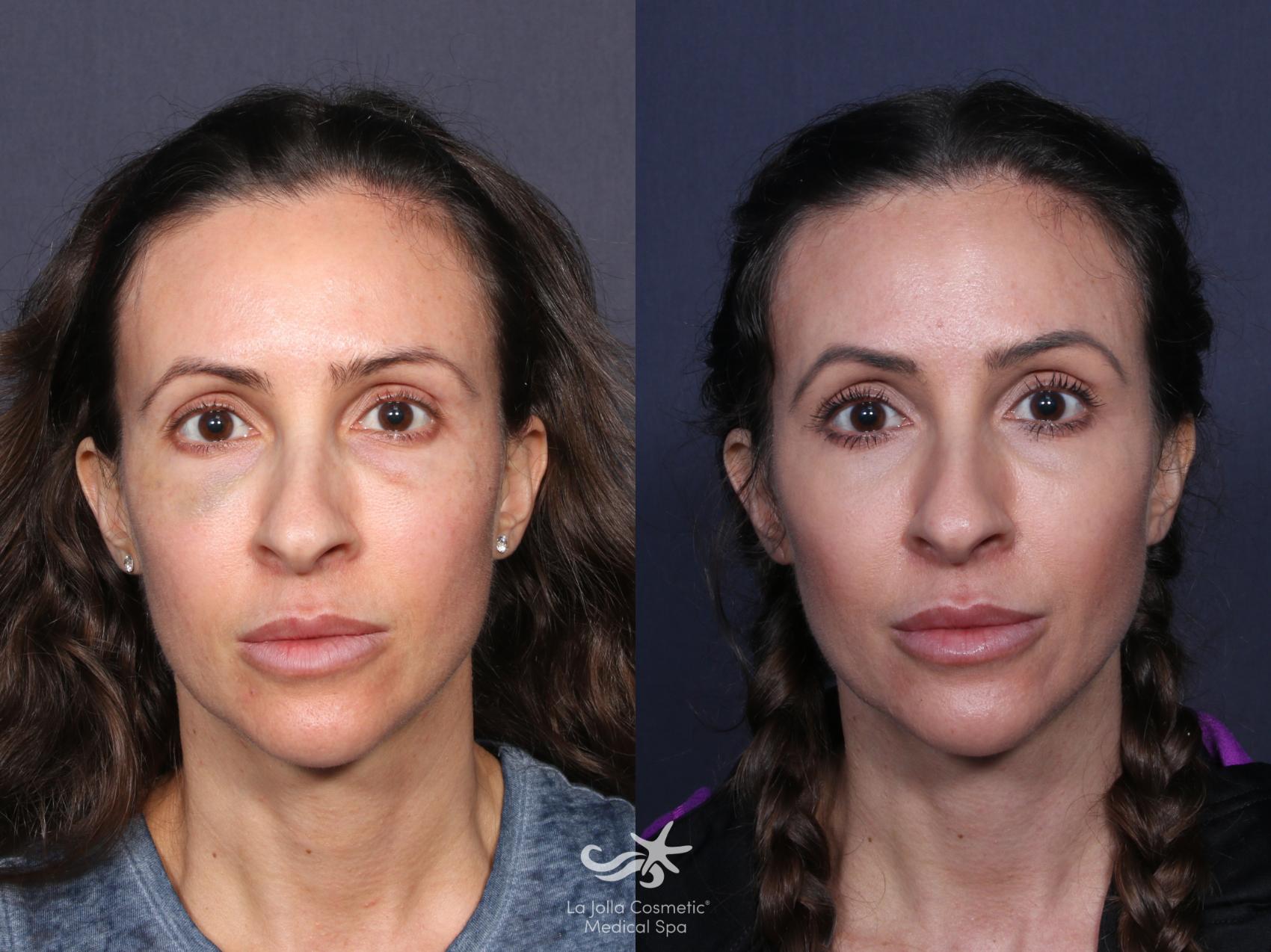 Before & After Collagen Stimulators (Sculptra, Radiesse, PDO) Result 48 Front View in San Diego, Carlsbad, CA