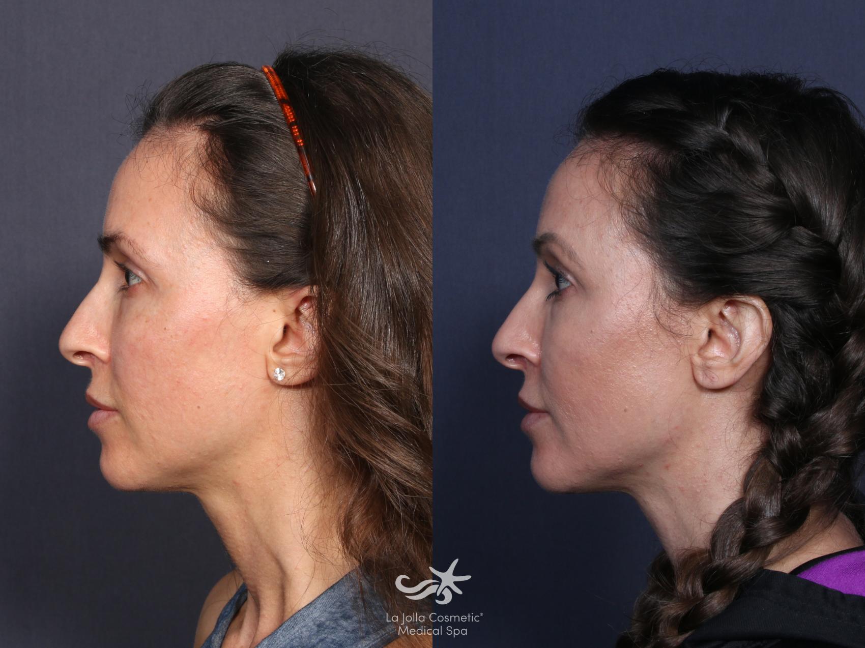 Before & After Collagen Stimulators (Sculptra, Radiesse, PDO) Result 48 Left Side View in San Diego, Carlsbad, CA