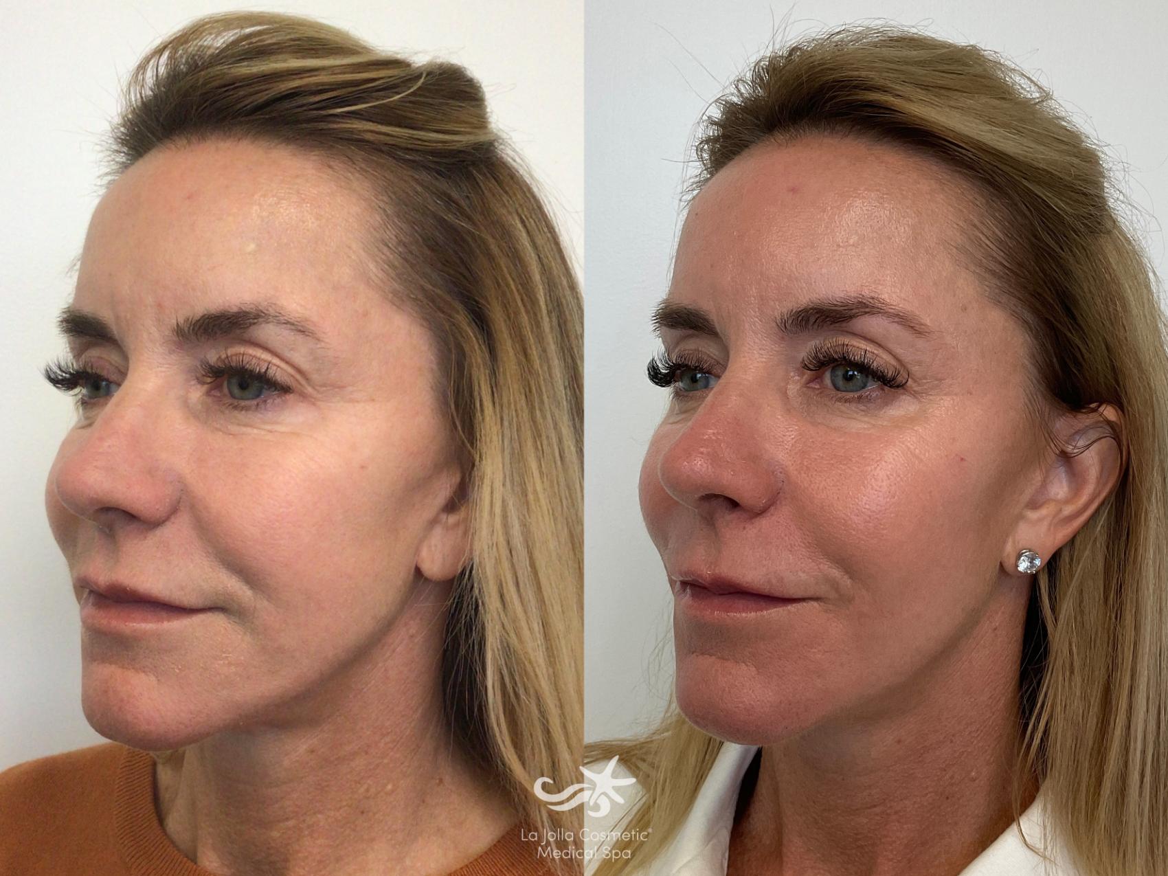 Before & After Collagen Stimulators (Sculptra, Radiesse, PDO) Result 720 Left Oblique View in San Diego, Carlsbad, CA
