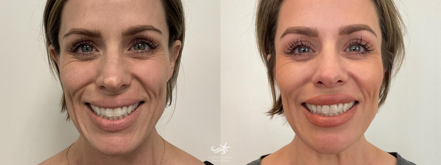 Before & After Collagen Stimulators (Sculptra, Radiesse, PDO) Result 750 Front Smile View in San Diego, Carlsbad, CA