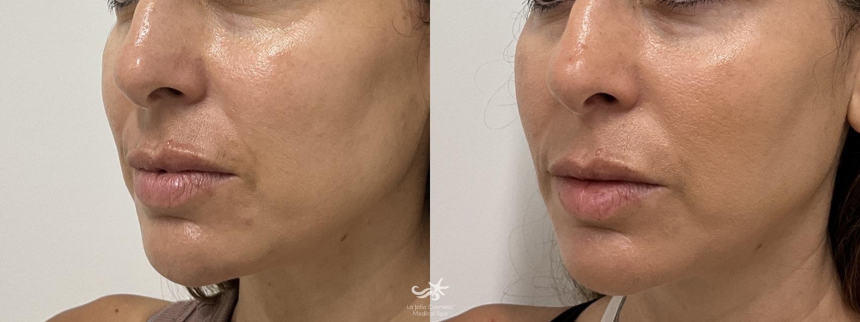 Before & After Collagen Stimulators (Sculptra, Radiesse, PDO) Result 911 Right Side View in San Diego, Carlsbad, CA