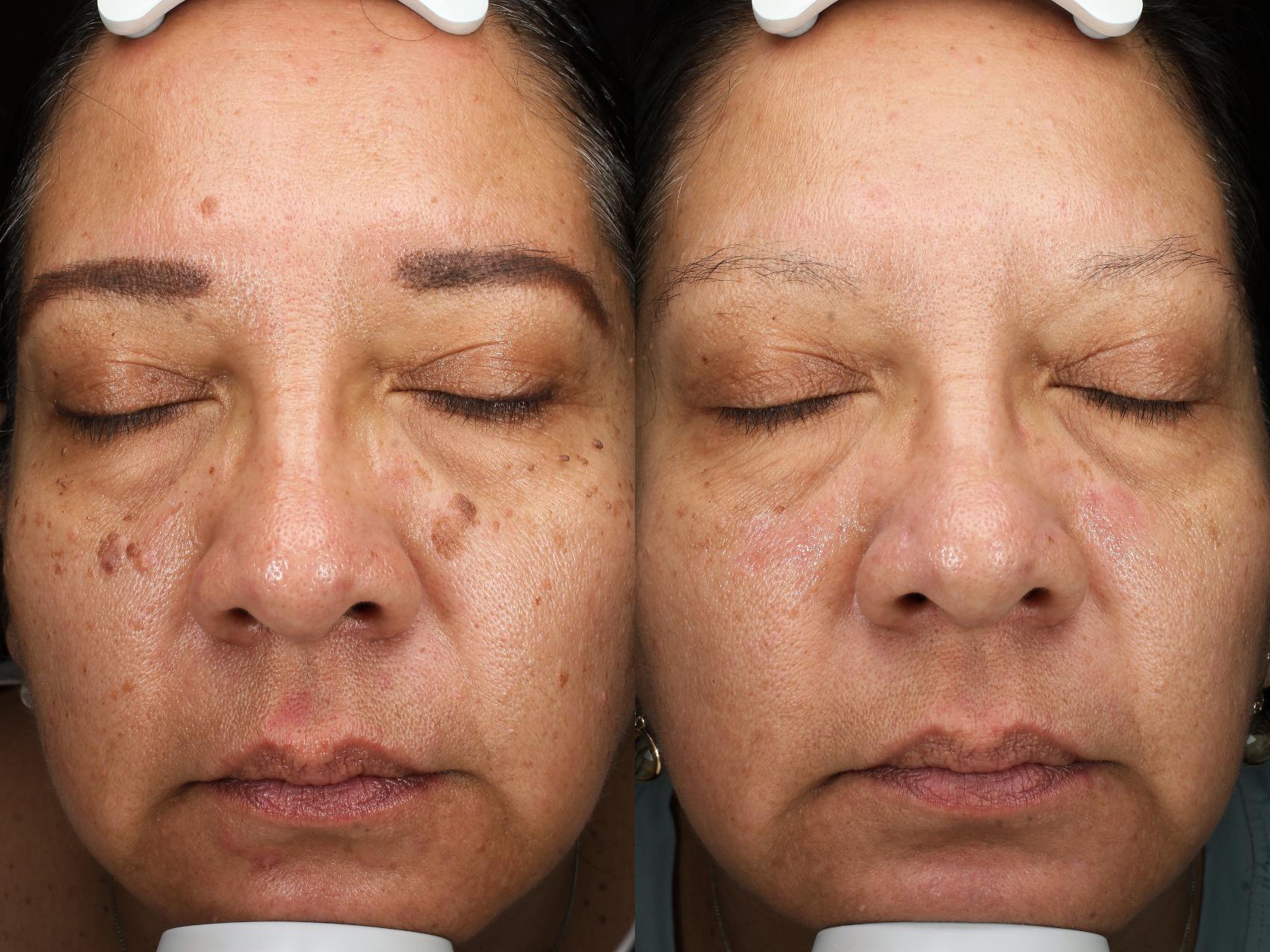 Before & After Contour TRL™ Laser Result 900 Front View in San Diego, Carlsbad, CA