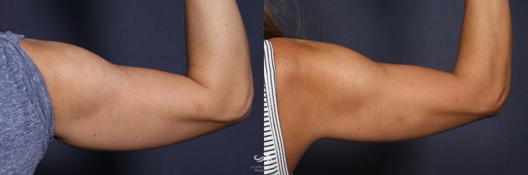 Before & After CoolSculpting® Result 136 Back Right Arm View in San Diego, Carlsbad, CA