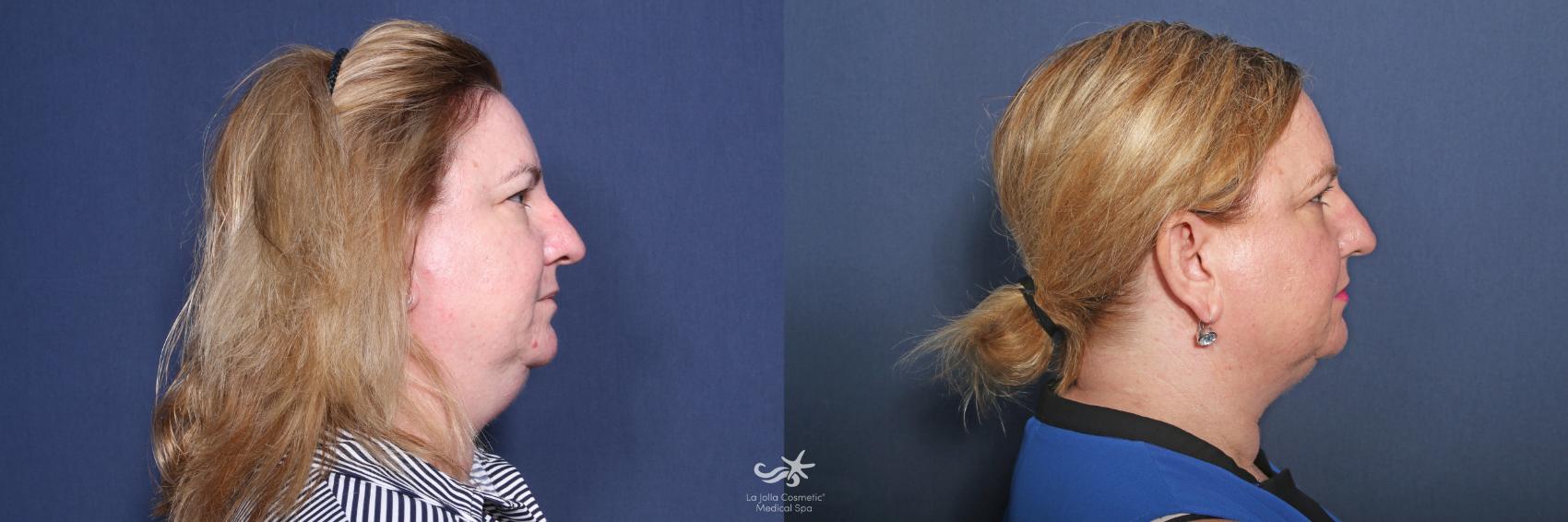 Before & After CoolSculpting® Result 538 Right Side View in San Diego, Carlsbad, CA