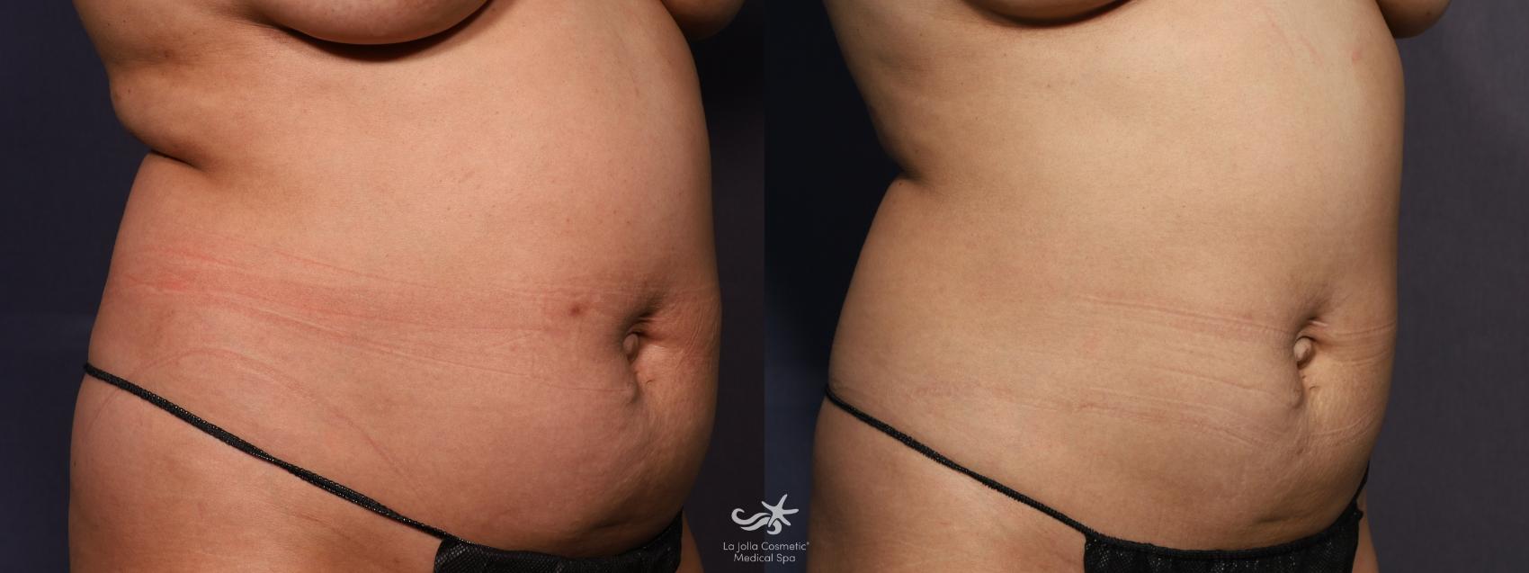 Before & After CoolSculpting® Result 860 Right Oblique View in San Diego, Carlsbad, CA