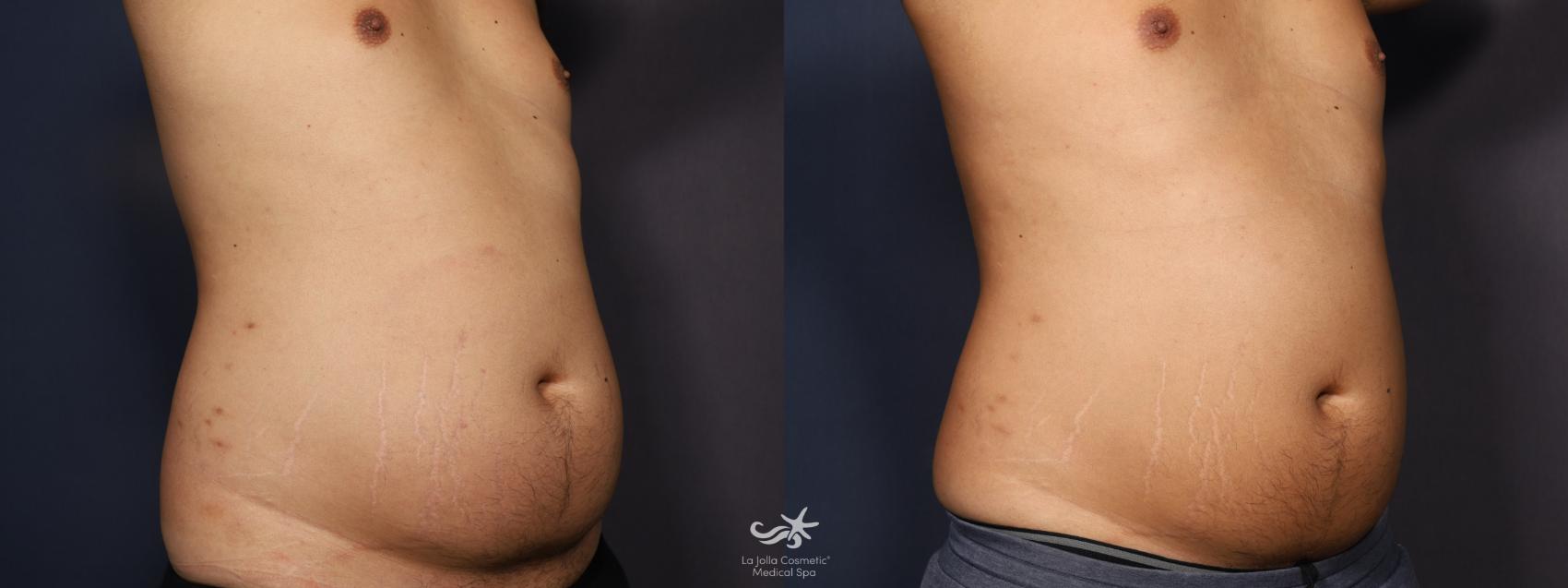 Before & After CoolSculpting® Result 908 Right Oblique View in San Diego, Carlsbad, CA