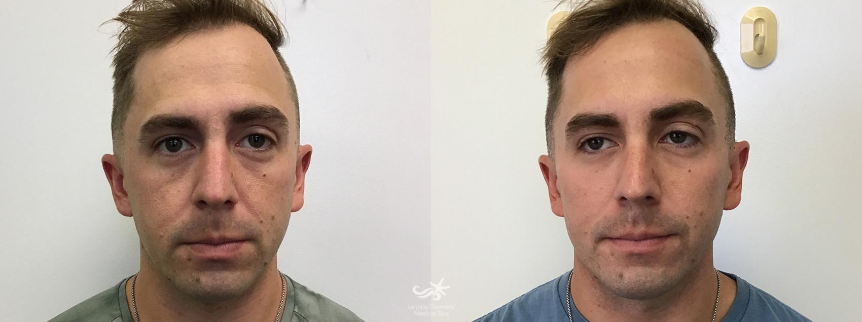 Before & After Dermal Fillers - All Results Result 547 Front View in San Diego, Carlsbad, CA