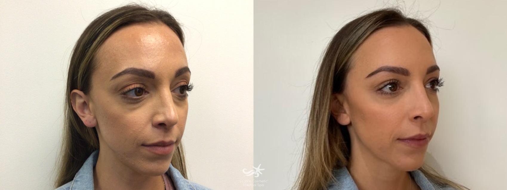 Before & After Dermal Fillers - All Results Result 651 Right Oblique View in San Diego, Carlsbad, CA