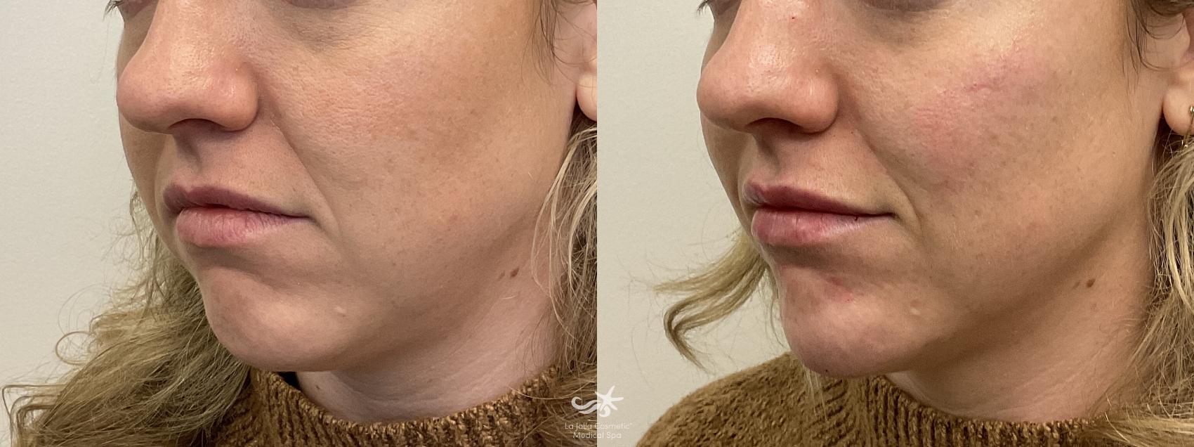 Before & After Dermal Fillers - All Results Result 835 Left Oblique View in San Diego, Carlsbad, CA