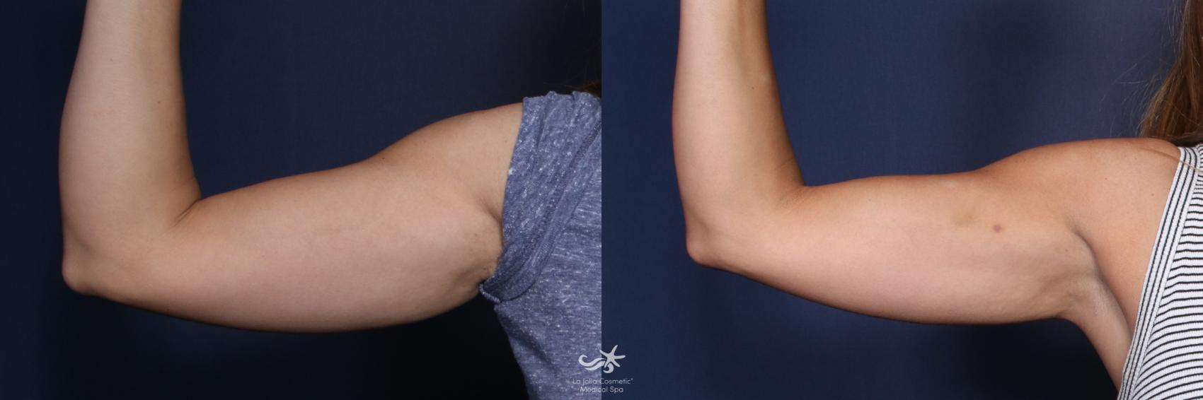 Before & After Fat Reduction Result 136 Front Right Arm View in San Diego, Carlsbad, CA