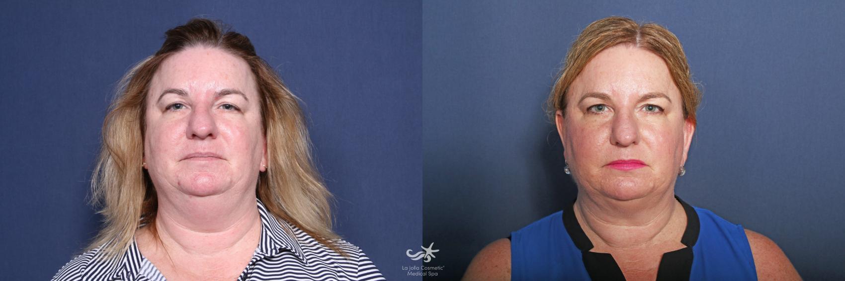 Before & After Fat Reduction Result 538 Front View in San Diego, Carlsbad, CA