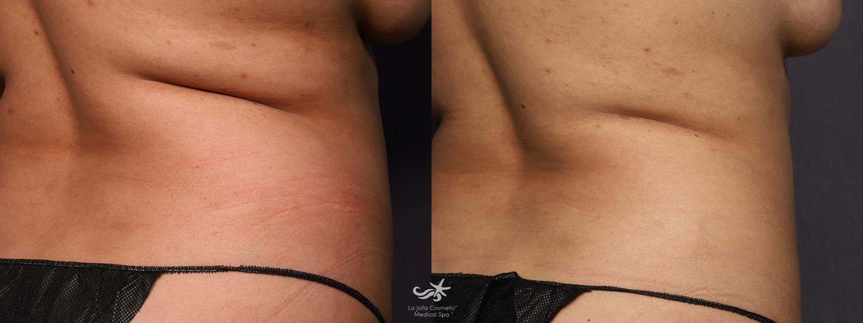 Before & After Fat Reduction Result 860 Back View in San Diego, Carlsbad, CA