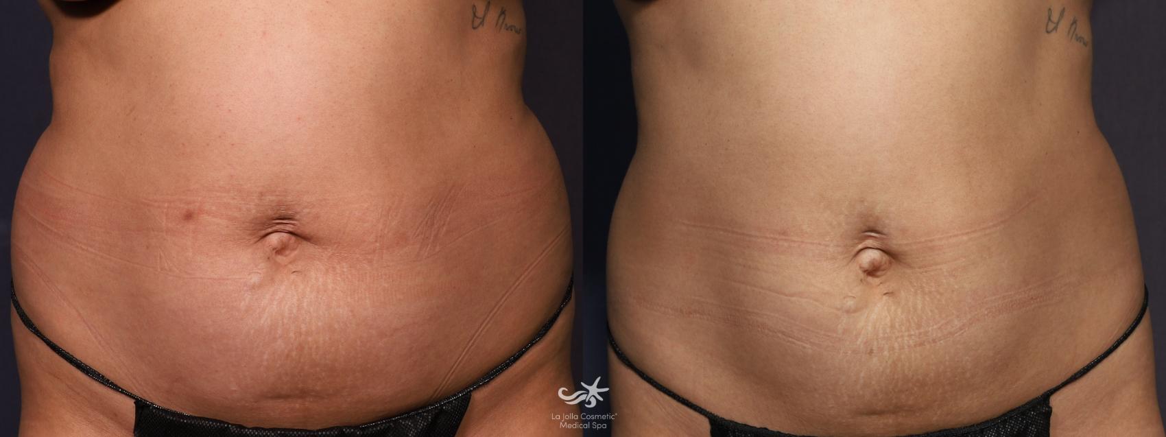 Before & After Fat Reduction Result 860 Front View in San Diego, Carlsbad, CA