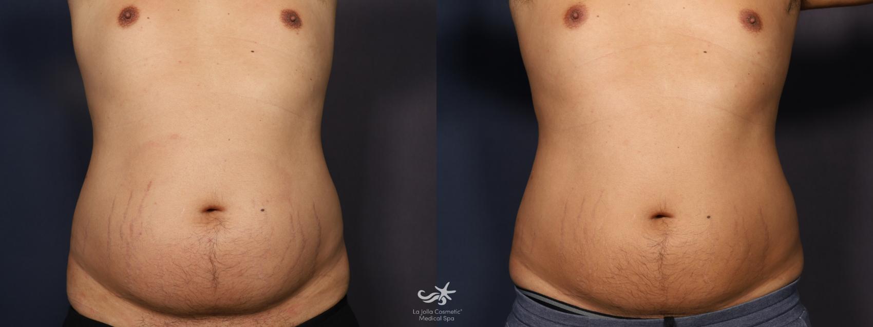 Before & After Fat Reduction Result 908 Front View in San Diego, Carlsbad, CA