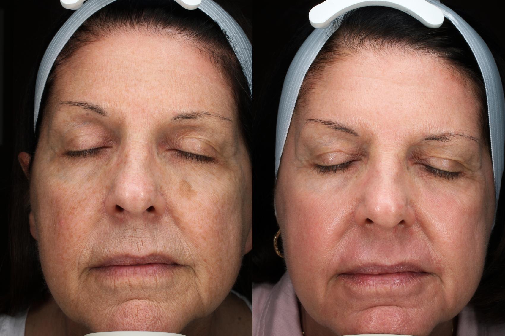 Before & After HALO™ Laser Treatment Result 116 Front View in San Diego, Carlsbad, CA