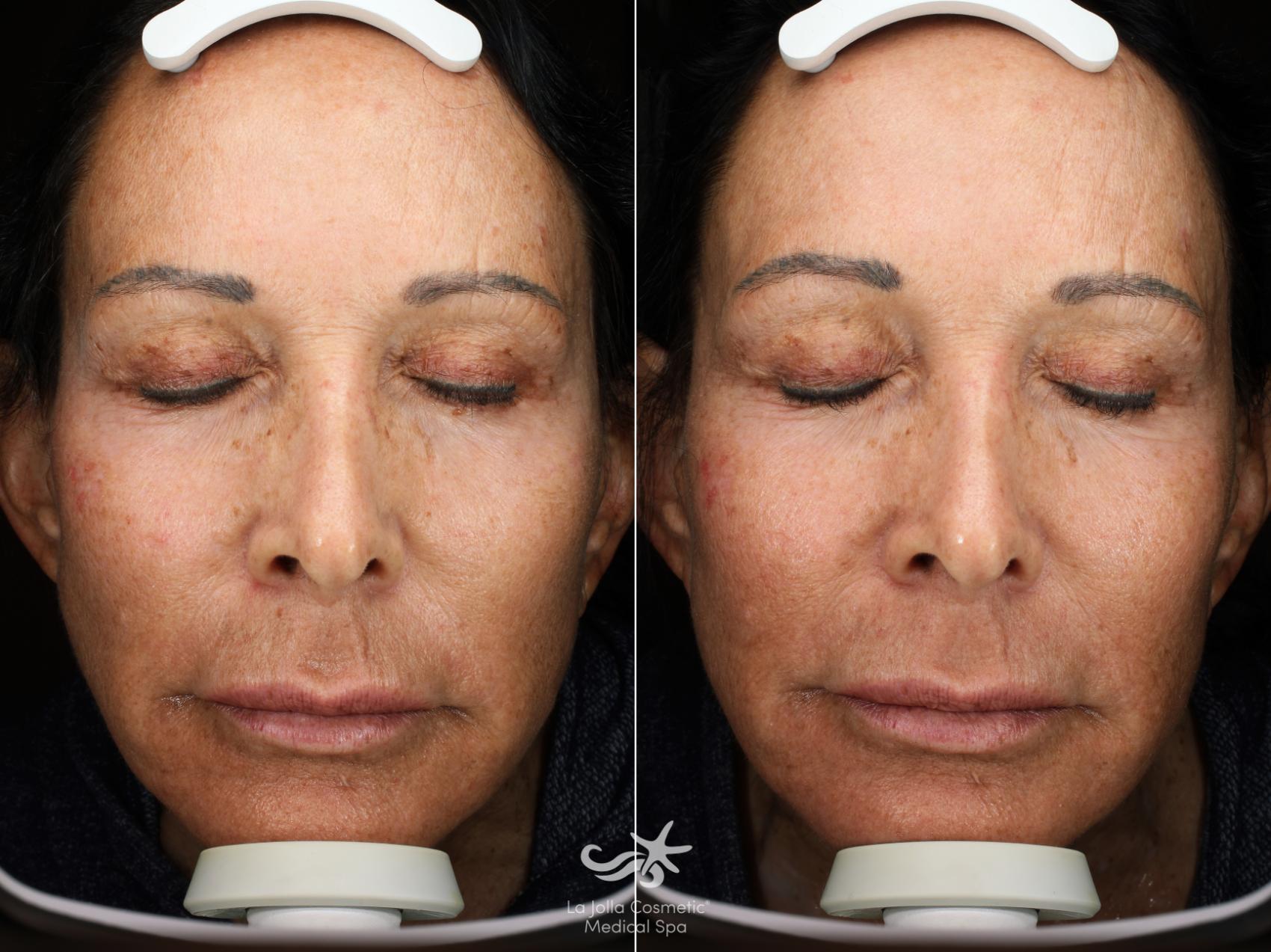 Before & After HALO™ Laser Treatment Result 541 Front View in San Diego, Carlsbad, CA