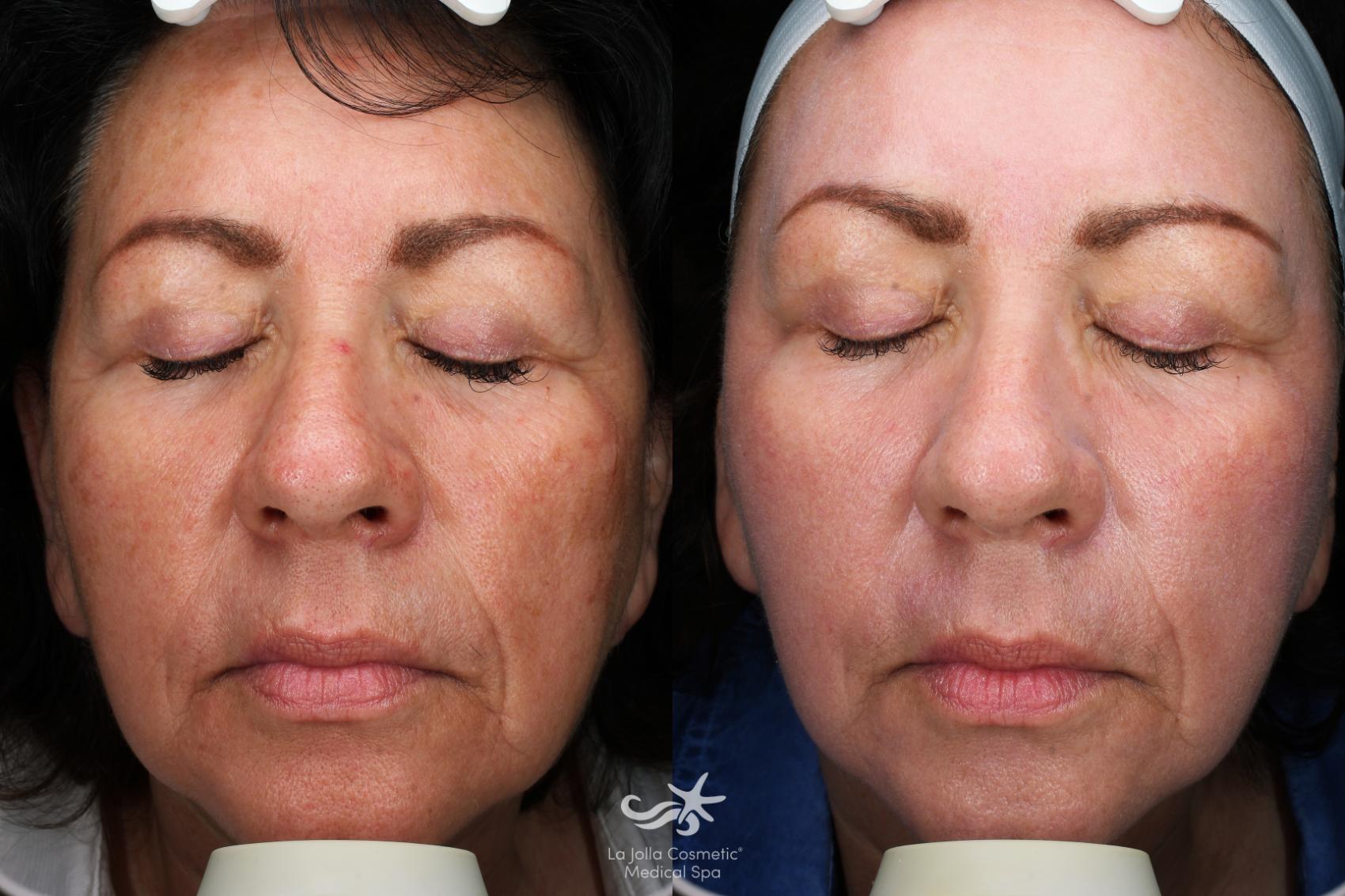Before & After HALO™ Laser Treatment Result 545 Front View in San Diego, Carlsbad, CA