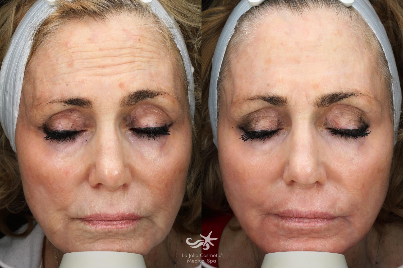 Before & After HALO™ Laser Treatment Result 677 Front View in San Diego, Carlsbad, CA