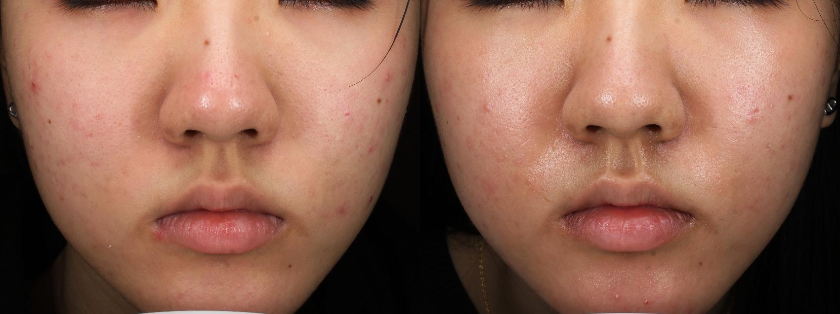 Before & After HALO™ Laser Treatment Result 776 Front View in San Diego, Carlsbad, CA
