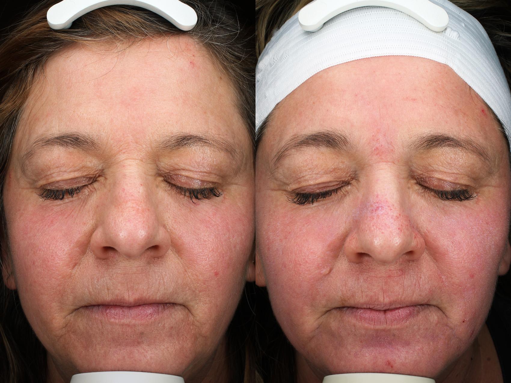 Before & After HALO™ Laser Treatment Result 832 Front View in San Diego, Carlsbad, CA