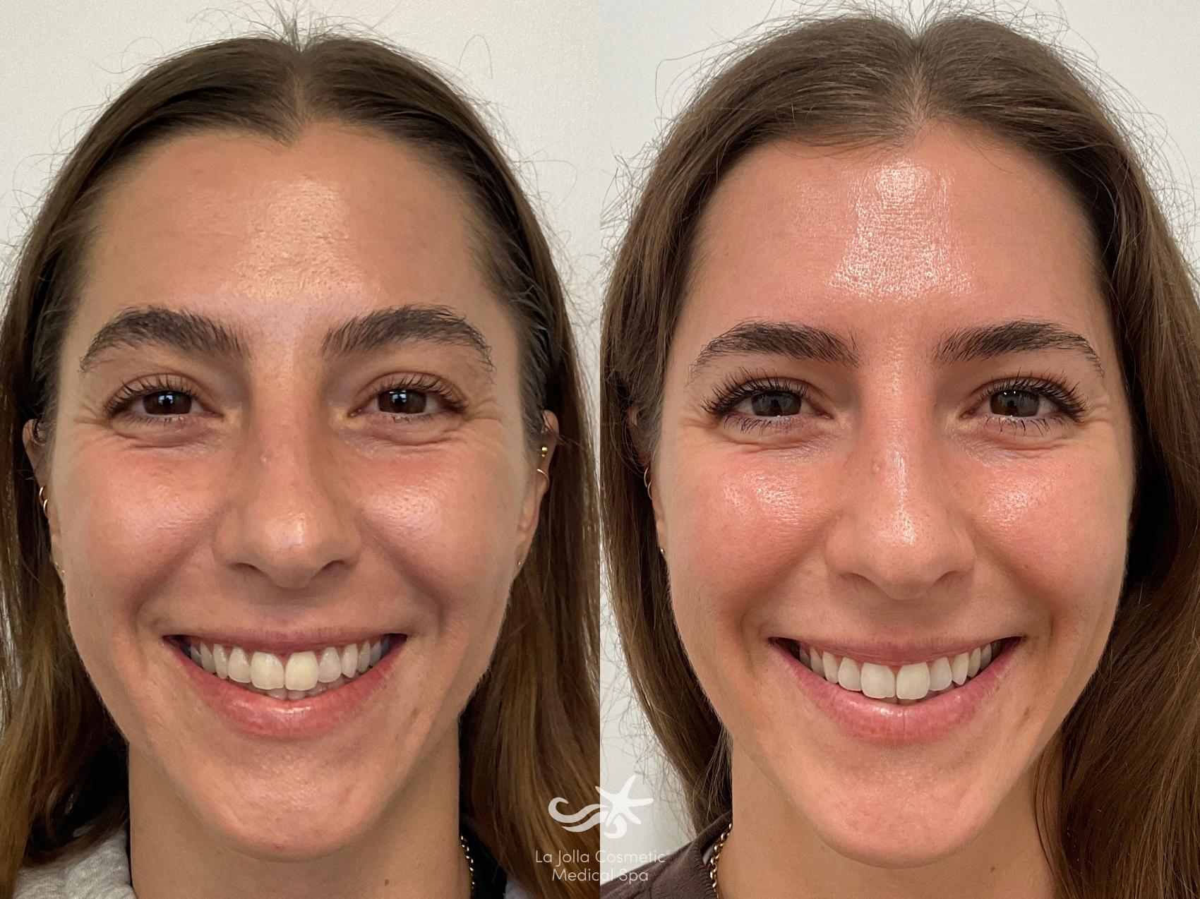 Before & After HALO™ Laser Treatment Result 845 Front Smile View in San Diego, Carlsbad, CA