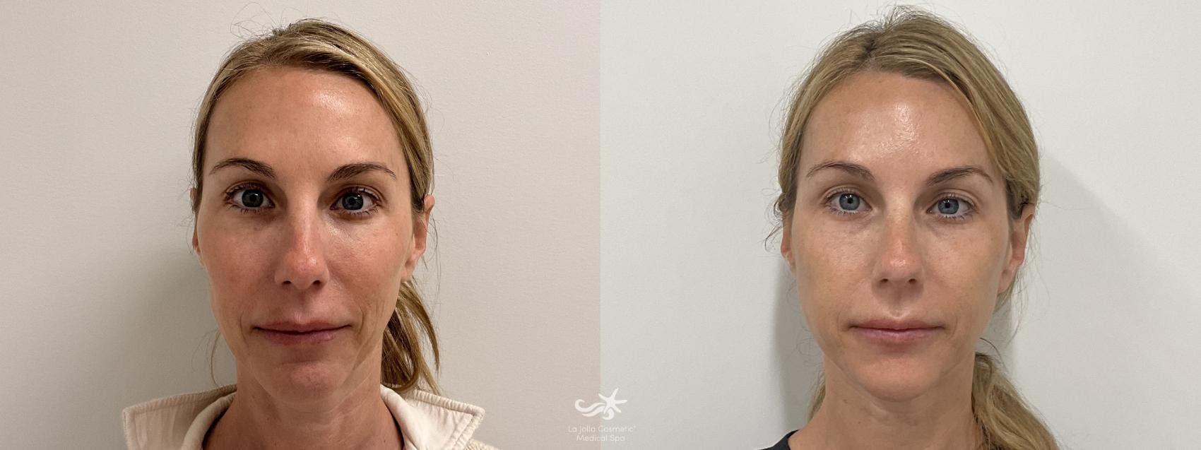 Before & After Juvéderm® Result 842 Front View in San Diego, Carlsbad, CA