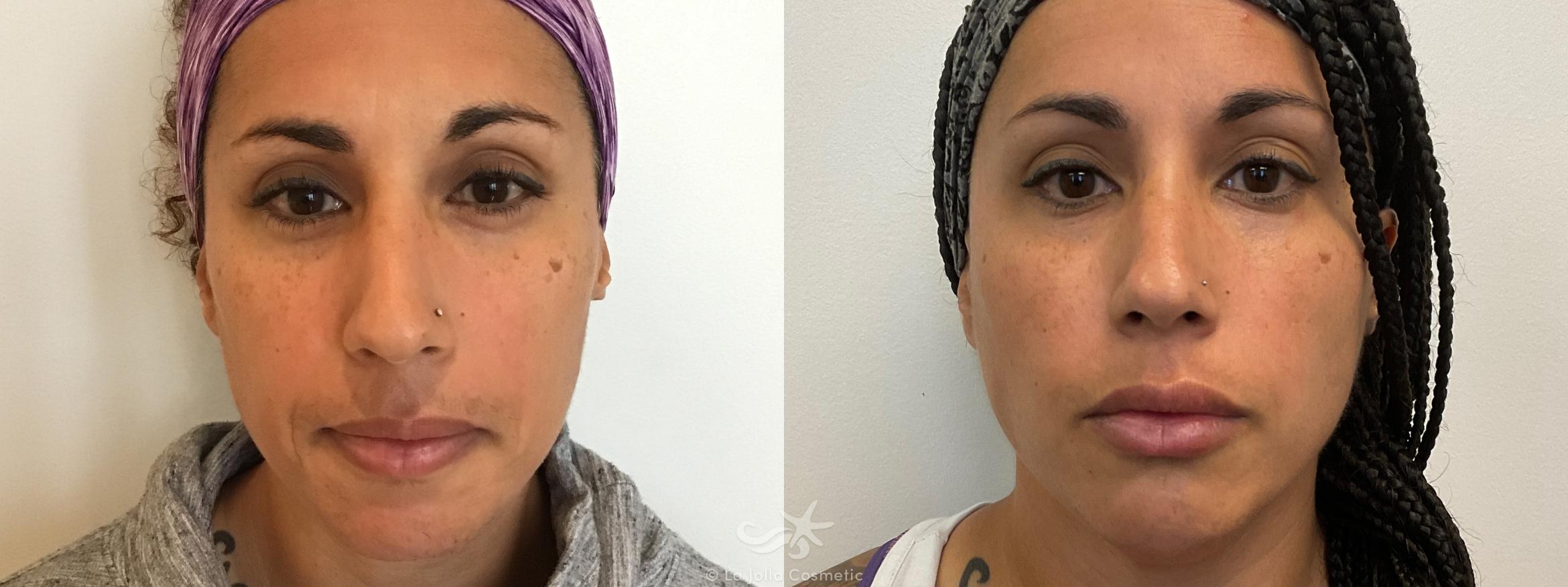 Before & After Juvéderm® Volbella™ Result 599 Front View in San Diego, Carlsbad, CA