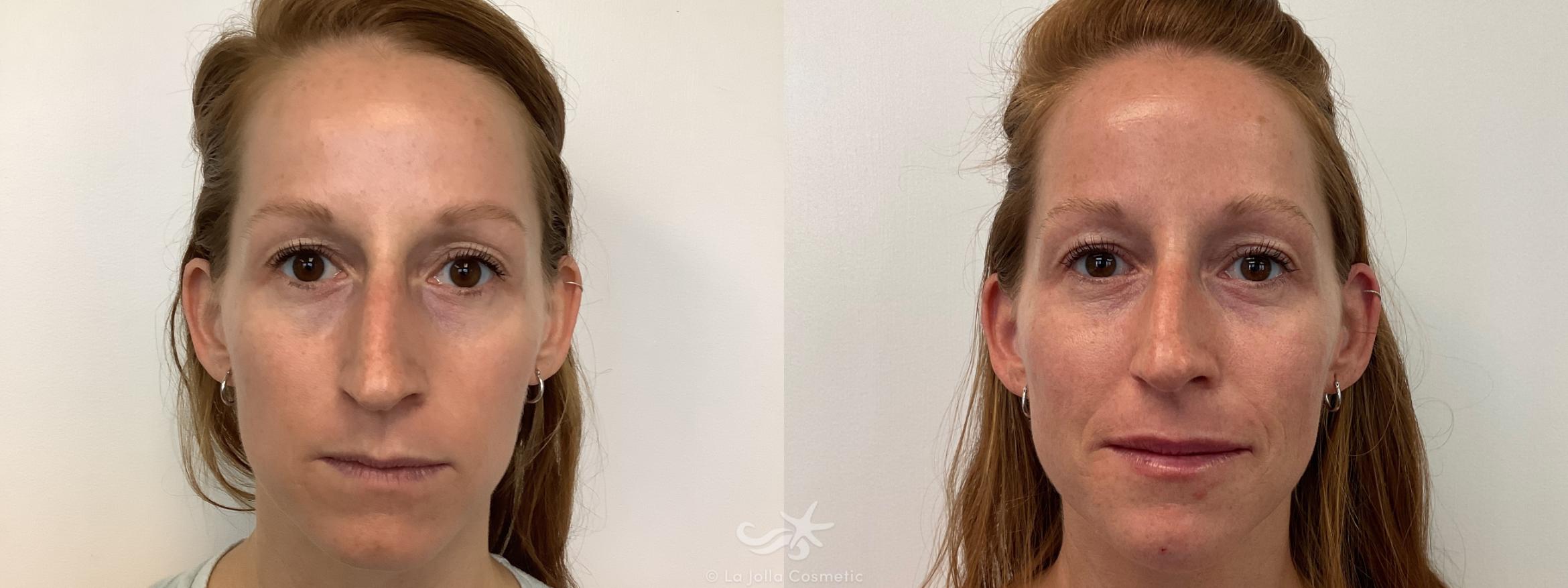 Before & After Juvéderm® Voluma™ Result 652 Front View in San Diego, Carlsbad, CA