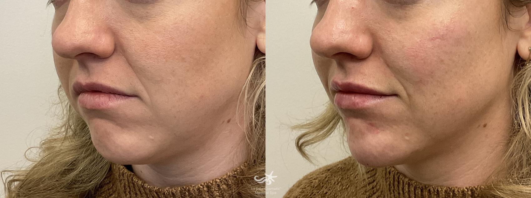 Before & After Juvéderm® Voluma™ Result 835 Left Oblique View in San Diego, Carlsbad, CA