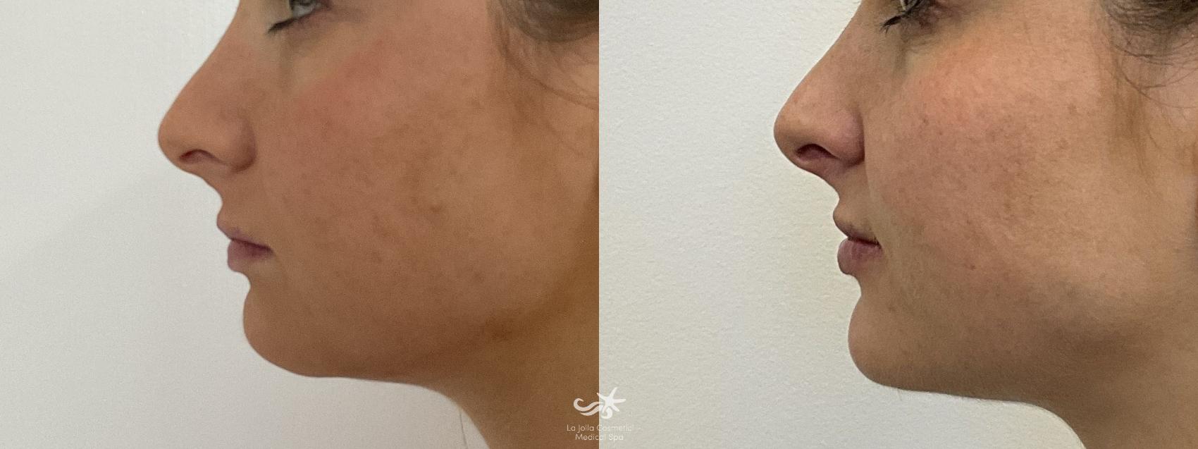 Before & After Juvéderm® Voluma™ Result 980 Left Side View in San Diego, Carlsbad, CA