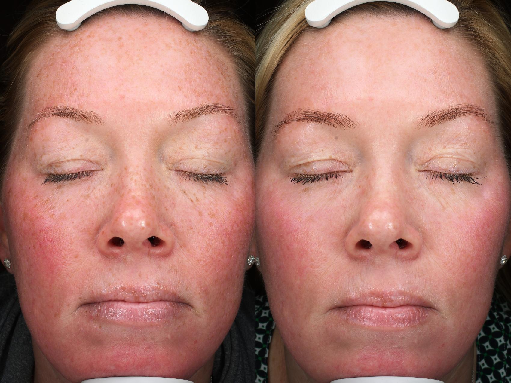 Before & After Laser Treatments Result 1048 Front View in San Diego, Carlsbad, CA