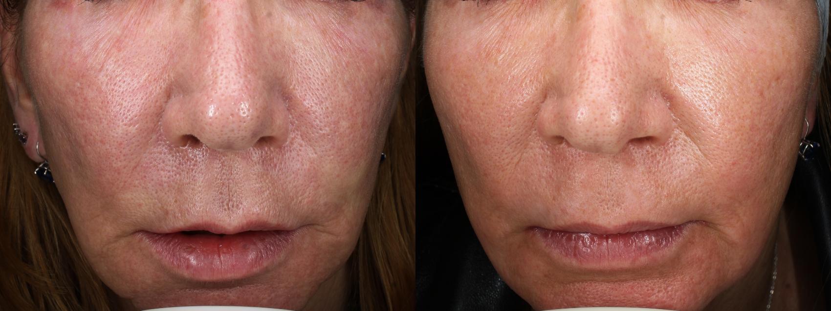 Before & After Laser Treatments Result 673 Front View in San Diego, Carlsbad, CA