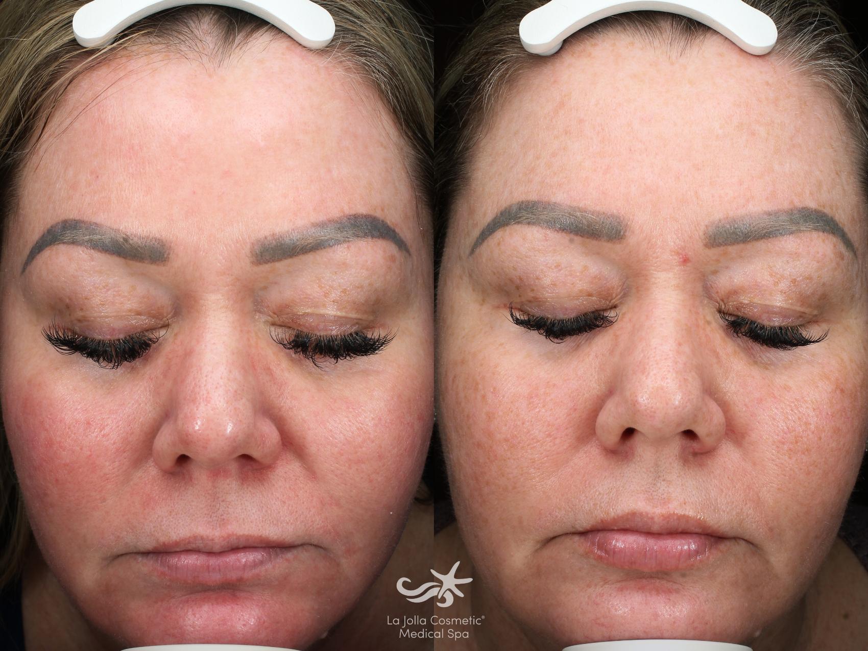 Before & After Laser Treatments Result 931 Front View in San Diego, Carlsbad, CA