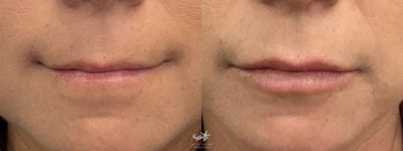 Before & After Lip Enhancement Result 755 Front View in San Diego, Carlsbad, CA