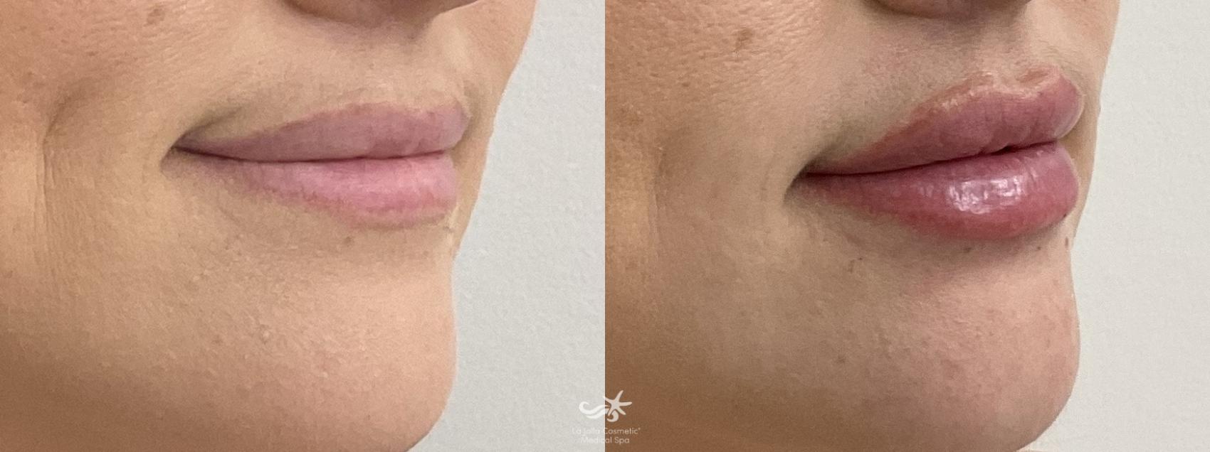 Before & After Lip Enhancement Result 813 Right Oblique View in San Diego, Carlsbad, CA