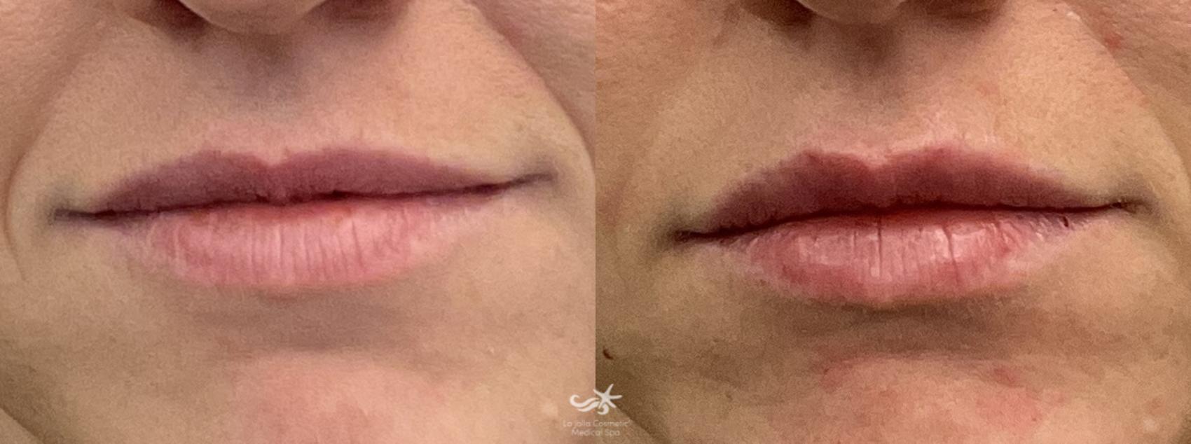 Before & After Lip Enhancement Result 834 Front View in San Diego, Carlsbad, CA