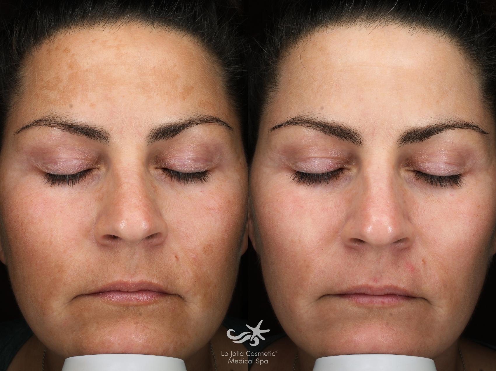 Before & After MOXI™ Laser Result 925 Front View in San Diego, Carlsbad, CA