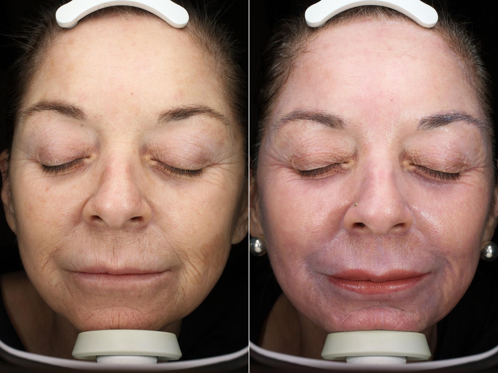 Before & After Profractional™ Laser Skin Resurfacing Result 543 Front View in San Diego, Carlsbad, CA