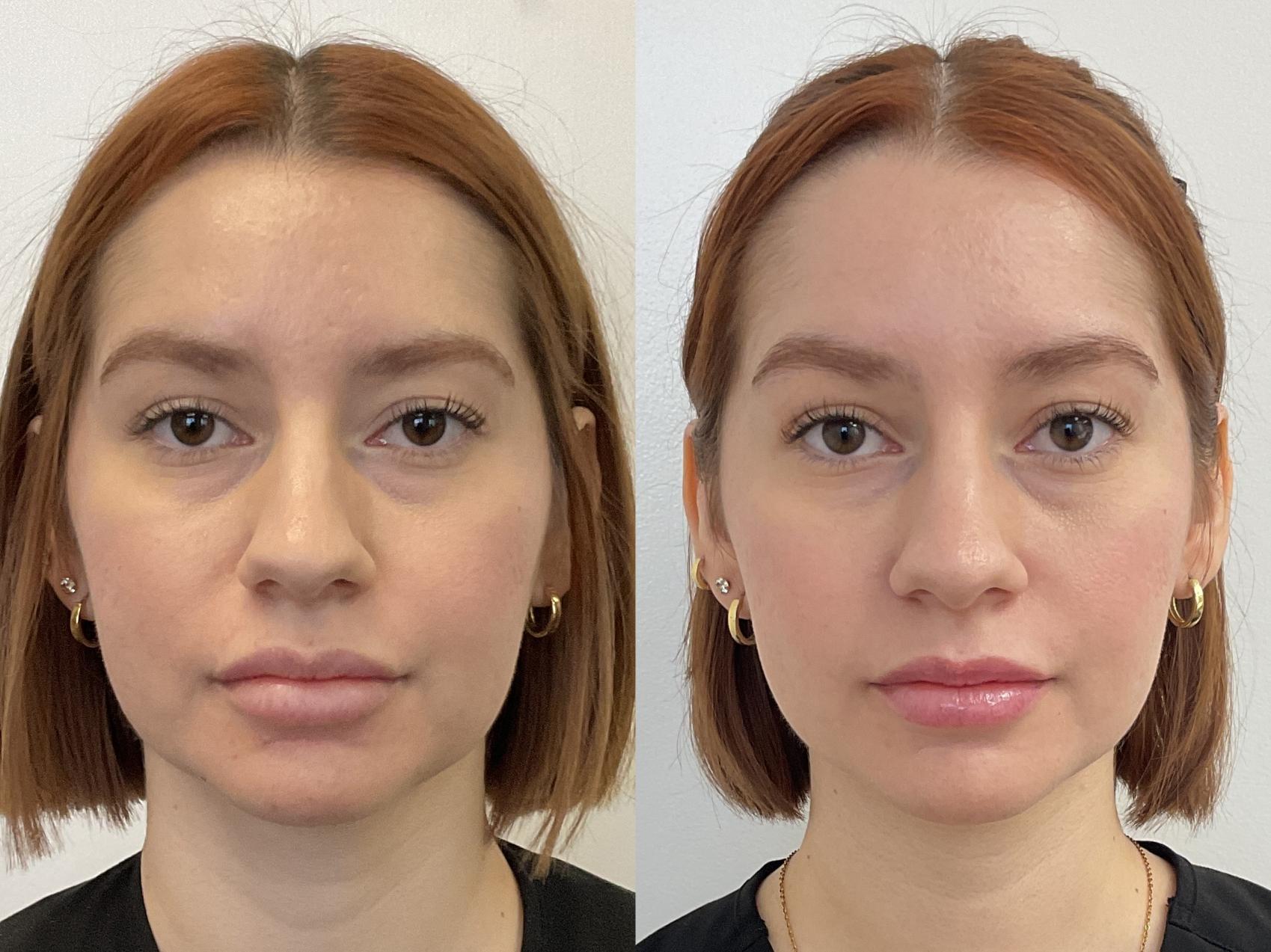 Before & After Restylane® Defyne Result 1051 Front View in San Diego, Carlsbad, CA